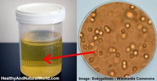 Image result for bacteria in urine