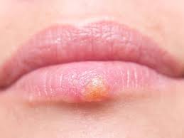 On the other hand, hsv type 2 causes the infection that involves genitals, buttocks and the lower back. Natural Herpes Treatment Lifeworks Wellness Center