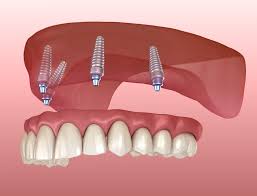 How do you know when it's time to reline dentures? Dental Implants Implant Fixed Dentures Tulsa Precision Dental