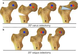 fem neck osteotomy in skeletally