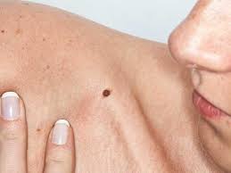 skin cancer pictures facts what you