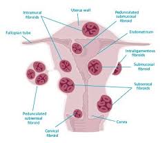 Uterine Fibroid Factsheet Zuellig Pharma Making
