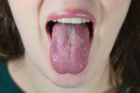 yeast infection on lips thrush