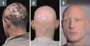 Alopecia is the medical term for hair loss. Finding New Treatments For Alopecia Areata Patients Feature Pharmaceutical Journal