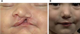 infant with incomplete cleft lip a