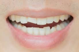 chipped tooth repair costs and treatment