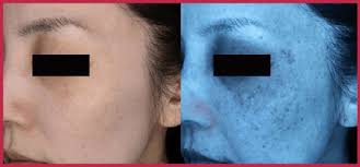 シミ予備軍・隠れシミを消すレーザー治療！顔のシミを増やさない対策方法！【40代でもシミがない肌に】 – 美メモ。