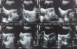 Image result for icd 10 code for leiomyoma of uterus in pregnancy