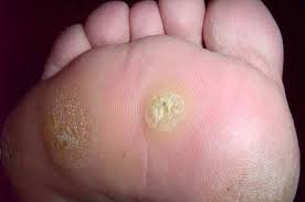 wart removal diagnosis and treatment