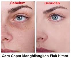 Check spelling or type a new query. Cara Menghilangkan Flek Hitam Di Wajah Secara Cepat Dengan Bahan Alami