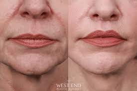 lip lift west end plastic surgery
