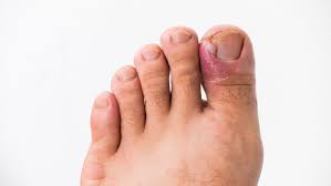how to treat infected ingrown toenail