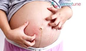 itching during pregnancy causes
