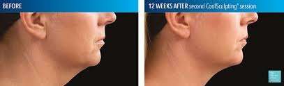 Maybe you would like to learn more about one of these? Sagging Jowls Treatment Liposuction For Sagging Jowls And Double Chin