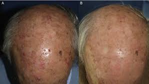 man with multiple actinic keratoses and