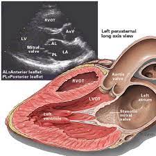 Mitral definition, of or resembling a miter. Mitral Stenosis Topic Review Learntheheart Com