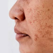 home remes to treat dark spots and
