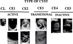 The 2001 world health organization (who) classification of hepatic hydatid cysts is used to assess the stage of hepatic hydatid cysts on ultrasound and is useful in deciding the appropriate management depending on the stage of the cyst. International Classification Of Ultrasound Images In Cystic Echinococcosis For Application In Clinical And Field Epidemiological Settings Sciencedirect