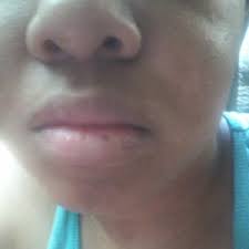 remove this dark spot on my bottom lip