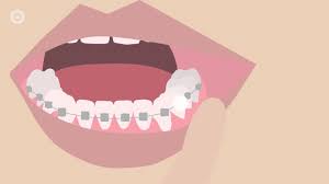 Benzocaine is a pain reliever that comes in a liquid or gel form and can be applied directly to your child's teeth and gums to help relieve braces pain. How To Deal With Braces Discomfort What S Normal What S Not What To Do Youtube