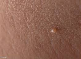 wart removal treatment in bangalore