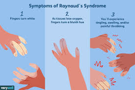 raynaud s syndrome symptoms diagnosis