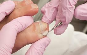 ingrown toenail procedure