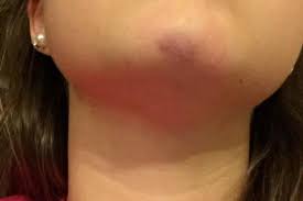 bruise like spot on my chin