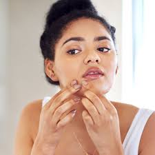 common acne flare up causes and