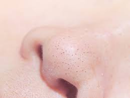 And how long have you been using the creams? Why You Have Blackheads On Nose Insider