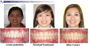 2 doctor answers • 2 doctors weighed in. Underbite Correction Without Surgery In Sugar Land And Houston