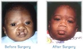 cleft lip palate department of