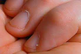 health advisory brittle finger nails
