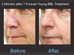 What You Should Know about Sciton's Forever Young BBL™ - Dy Dermatology Center