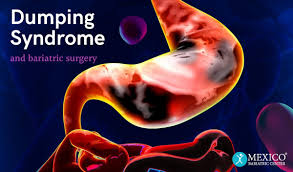 dumping syndrome after bariatric