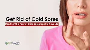 cold sores effective home remes