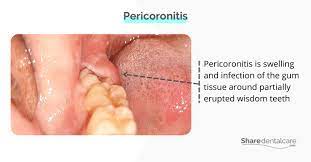 pericoronitis home remedy share