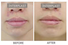 lip reduction in thailand interplast