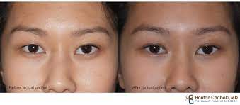 double fold with upper eyelid surgery