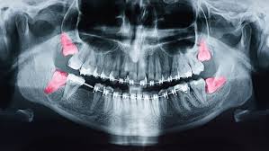 wisdom teeth koehn dentistry aesthetics