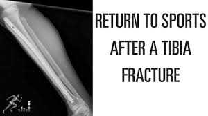 return to sports after a tibia fracture