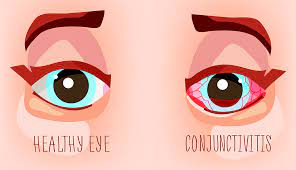 pink eye what are the symptoms and how