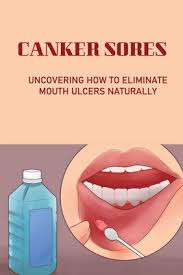 canker sores uncovering how to