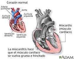 Learn about the symptoms, diagnosis, and treatment of myocarditis. Miocarditis Medlineplus Enciclopedia Medica