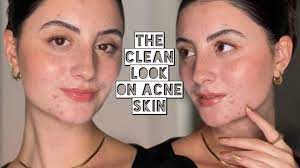 clean look on acne skin