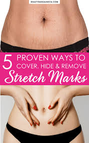 4 ways to remove stretch marks 1 way