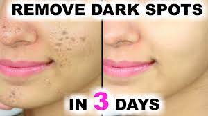 black spots acne scars anaysa