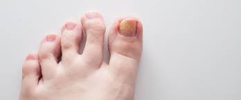 toenail fungus treatments mesa az