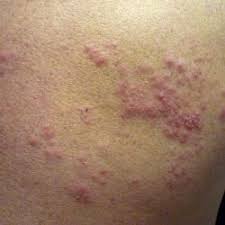 Shingles is a condition that you can develop if you've had chickenpox before. New Shingles Vaccine Victim Of Its Own Success American Council On Science And Health