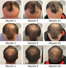 Bauman stresses that it is not dht production that causes hair loss, it's the. Hair Growth Success Makes Me Feel Younger